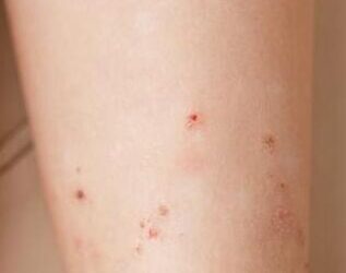 Štípnutí od blechy