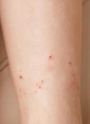 štípnutí od blechy