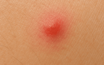 Štípanec od blechy foto