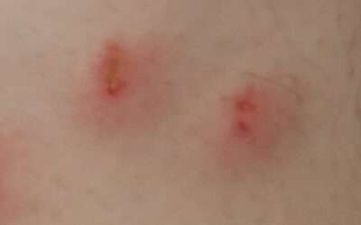 Štěnice pokousání