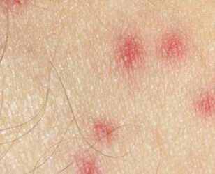 Štípance od štěnic foto