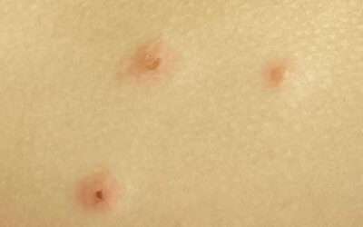 Jak vypadá pokousání od štěnic